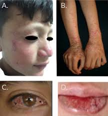 Image result for Photodermatitis