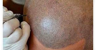 Nutra System Hair Pigmentations Sac Dovmesi Simulasyon Sac Sac Dokulme Tedavileri Sac Dokulmesi