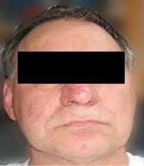 Coblation of rhinophyma