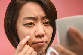 Tahi lalat adalah bintik kecil berwarna cokelat atau kehitaman di atas permukaan kulit. Wajah Memiliki Banyak Tahi Lalat Normalkah