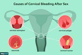 Postcoital Bleeding: What Causes Bleeding After Sex