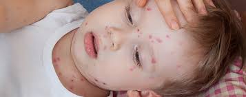 Maybe you would like to learn more about one of these? Alergi Kulit Pada Anak Dan Cara Mengatasinya Nutriclub Nutriclub