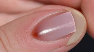 Image result for Akutní zánět nehtového lůžka