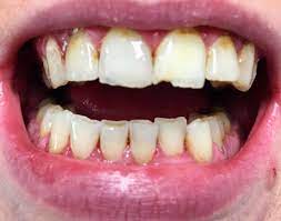 The Outer Layer Is Essentially Lifeless Meaning It Has No Living Cells Or Nerves Grinding Can Damage Or Destroy Your Enam Dental Quotes Bruxism Dental Clinic