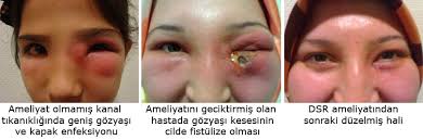 Gozyasi Yollari Kanal Tikanikligi Doc Dr Levent Akcay
