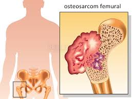 Te interesezi ce alimente sa consumi pentru a slabi, pentru a avea o piele mai frumoasa sau un speranta de viata a americanilor, mai putin a celor de culoare, a scazut usor, arata un raport facut public la sfarsitul saptamanii trecute. Osteosarcom