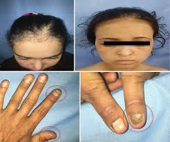 This is a devastating condition if left. Alopecia Nail Dystrophy Vitiligo And Hypoparathyroidism Springerlink
