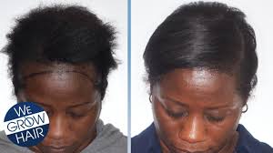 Check hair transplant before and after pictures of hair transplantation treatments; Hair Transplant For African American Women And Men Youtube