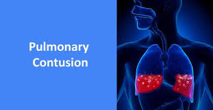Image result for Pulmonary Contusion