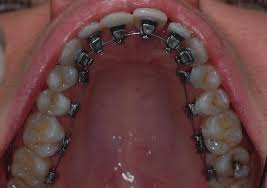 Call to see orthodontist dr. Http Sido Ejco Journal Org Pubblicazioni Vol4iss3 Ejco Vol4iss3 Pdf