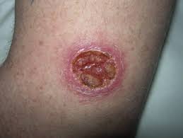 Image result for Fly Bite