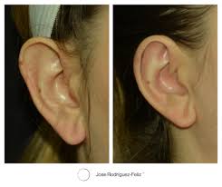 These molds, when applied at a young enough age, will reshape. If You Have Ever Wanted Smaller Ears Macrotia Ear Surgery Is For You