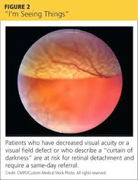 Image result for Decreased Visual Acuity