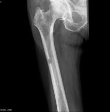 Med hjelp av mikrobobler kan pasienter med uhelbredelig kreft i bukspyttkjertelen leve dobbelt så lenge. Myelomatose Store Medisinske Leksikon