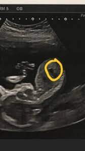 Full Bladder In Ultrasound December 2018 Birth Club Babycenter Canada