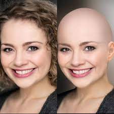 This Is A Before And After Of Carriehopefletcher Before With Her And After Bald Bald Head Women Woman Shaving Bald Hair