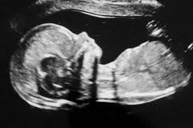 In der regel wird das gehalt am ende des monats oder am anfang eines monats überwiesen. Sonnenschein Spina Bifida Zwilling Bfvek E V