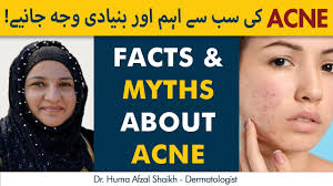 Facts & Myths About Acne