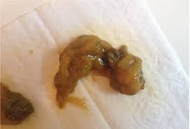 Megasporebiotic vindecă diareea cronică diareea cauze simptome tratament sfaturimedicalero. Noutate Ce SiguranÈÄ Scaun Cu Mucus Si Sange Home Land Ro