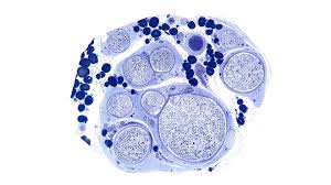 Image result for Microscopic Polyangiitis