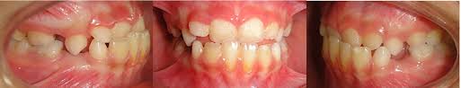 This appliance can serve as an alternative to other methods of anterior crossbite correction in the permanent dentition. Early Treatment Of Anterior Crossbite Relating To Functional Class Iii Intechopen