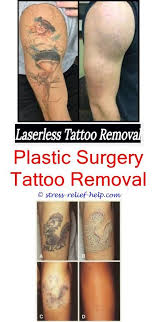 How Do U Remove A Tattoo Do The Tattoo Removal Creams Work Will Hair Grow Back After Laser Tattoo Removal Ta Tattoo Removal Tattoo Removal Cream Laser Tattoo