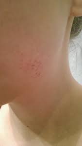Hautausschlag Gesicht Hals Haut Allergie Ausschlag