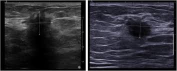 Epidemiology these account for ~1% of breast cancers. Are Baseline Ultrasound And Mammographic Features Associated With Rates Of Pathological Completes Response In Patients Receiving Neoadjuvant Chemotherapy For Breast Cancer Cancer Imaging Full Text