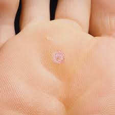 We did not find results for: How To Get Rid Of Plantar Warts Getridofthings Com