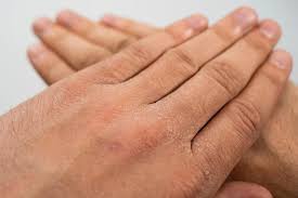 Da khô sần sùi: Nguyên nhân và cách điều trị hiệu quả• Hello Bacsi