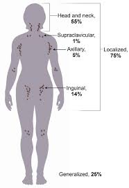 Cancer is found in groups of lymph nodes both above and below the diaphragm; Lymphadenopathy Cancer Therapy Advisor