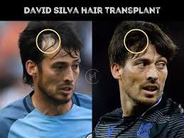 David Silva Hair Transplant