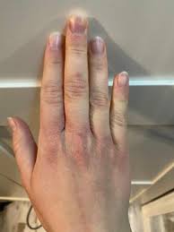Die neurodermitis (= atopische dermatitis) ist eine chronischentzüdlichehauterkrankung, die in schüben verläuft. Trockene Und Geschwollene Hand Neurodermitis Trockene Hande