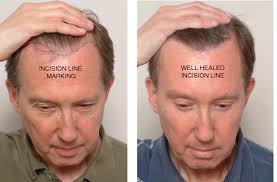 best hair loss treatment in chandigarh Archives