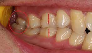 We did not find results for: Factors Affecting Impaction Of Wisdom Teeth And Their Mechanisms Springerlink