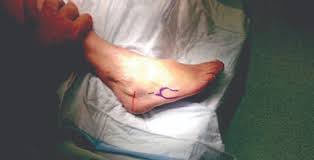A protective boot, cast, or stiff. A Guide To Intramedullary Fixation Of Jones Fractures Podiatry Today