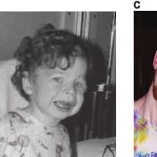 PDF) Mechanisms and treatment of cardiovascular disease in Williams-Beuren  syndrome