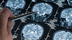 In caso di sintomi compatibili con la presenza di un aneurisma cerebrale contattare il medico con. Sapresti Riconoscere Un Aneurisma Cerebrale E Letale Ecco A Cosa Prestare Attenzione