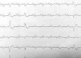 Image result for Extrasystole