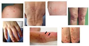 ▷ Dermatitis Herpetiforme y Celiaquía [ 32 FOTOS ] Síntomas causas y ...