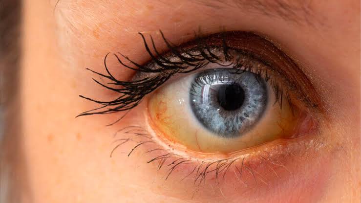 Gelbe Augen und ihre Ursachen erklärt - Bányai Augenheilkunde