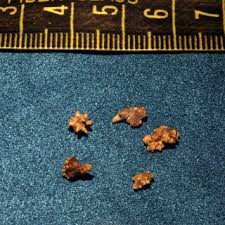 Kidney Stones Durward Black Md