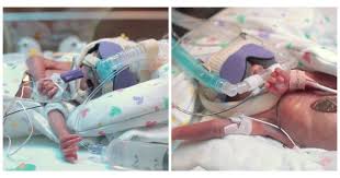 Une grossesse se prépare en 9 mois, et non en 3 mois et demi ! Premature De 4 Mois Ce Bebe Fragile Et En Pleine Detresse Va Vous Serrer Le Coeur Purebreak