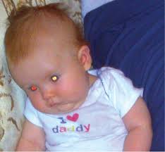 Image result for Red Reflex