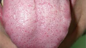 Image result for yellow tongue infection