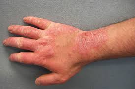Image result for Contact Dermatitis