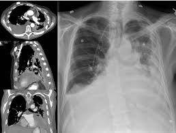 Learn more about this new mesothelioma . Fda Approves Nivolumab Ipilimumab Combo For First Line Mesothelioma Treatment