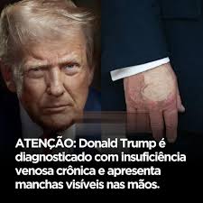 Donald Trump foi diagnosticado com insuficiência venosa crônica, uma  condição comum em pessoas mais velhas que dificulta a circulação do sangue  nas pernas. Segundo o comunicado médico, o presidente dos EUA apresentou