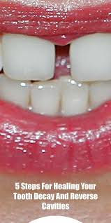 14 Steps For Healing Your Tooth Decay And Reverse Cavities Bestoralcareadvice Whatsoralcare Howimportantisoralcare Wh In 2020 Reverse Cavities Tooth Decay Cavities
