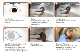 Image result for Lateral Canthotomy